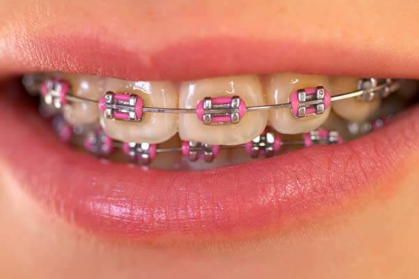 Clear Braces