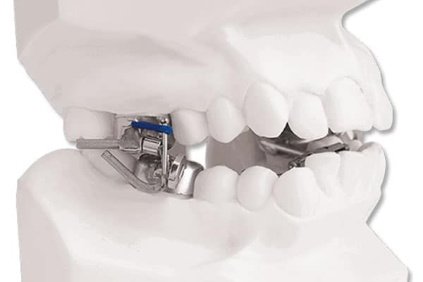 Orthodontic retainers